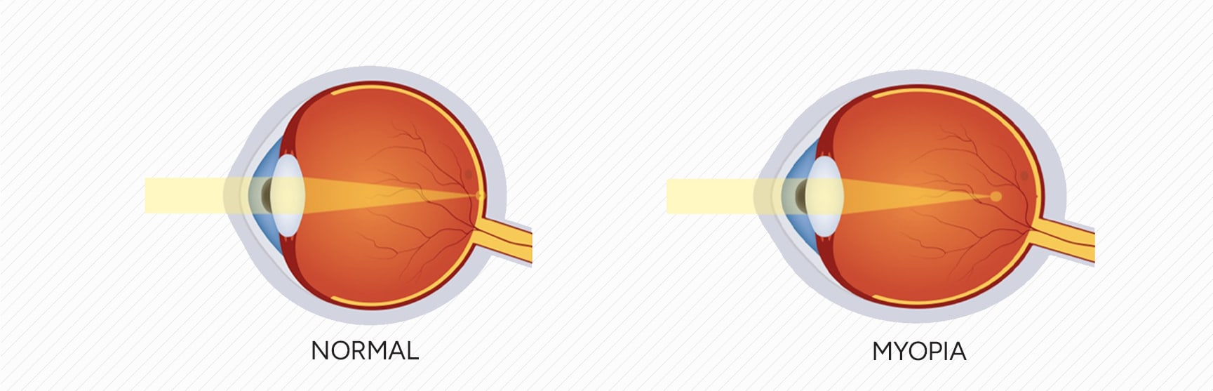 Diagram comparing the way light focuses in a normal eye versus a myopic one.