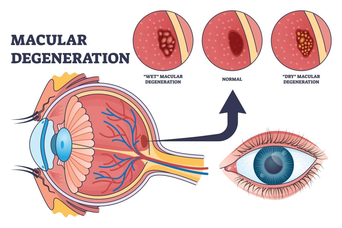 Illustration of the eye showing the macula with comparisons of normal, dry, and wet macular degeneration.