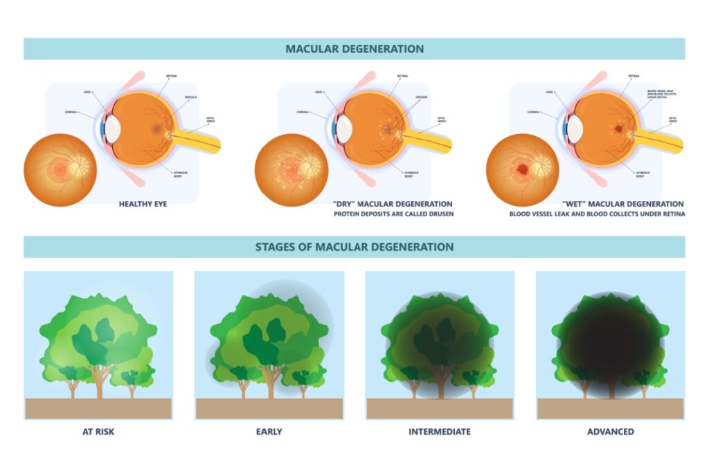 Eye cross sections and vision loss progression illustration.