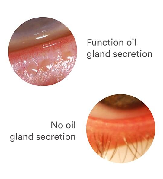 Comparison of eyelids with normal oil gland secretion versus no oil gland secretion.
